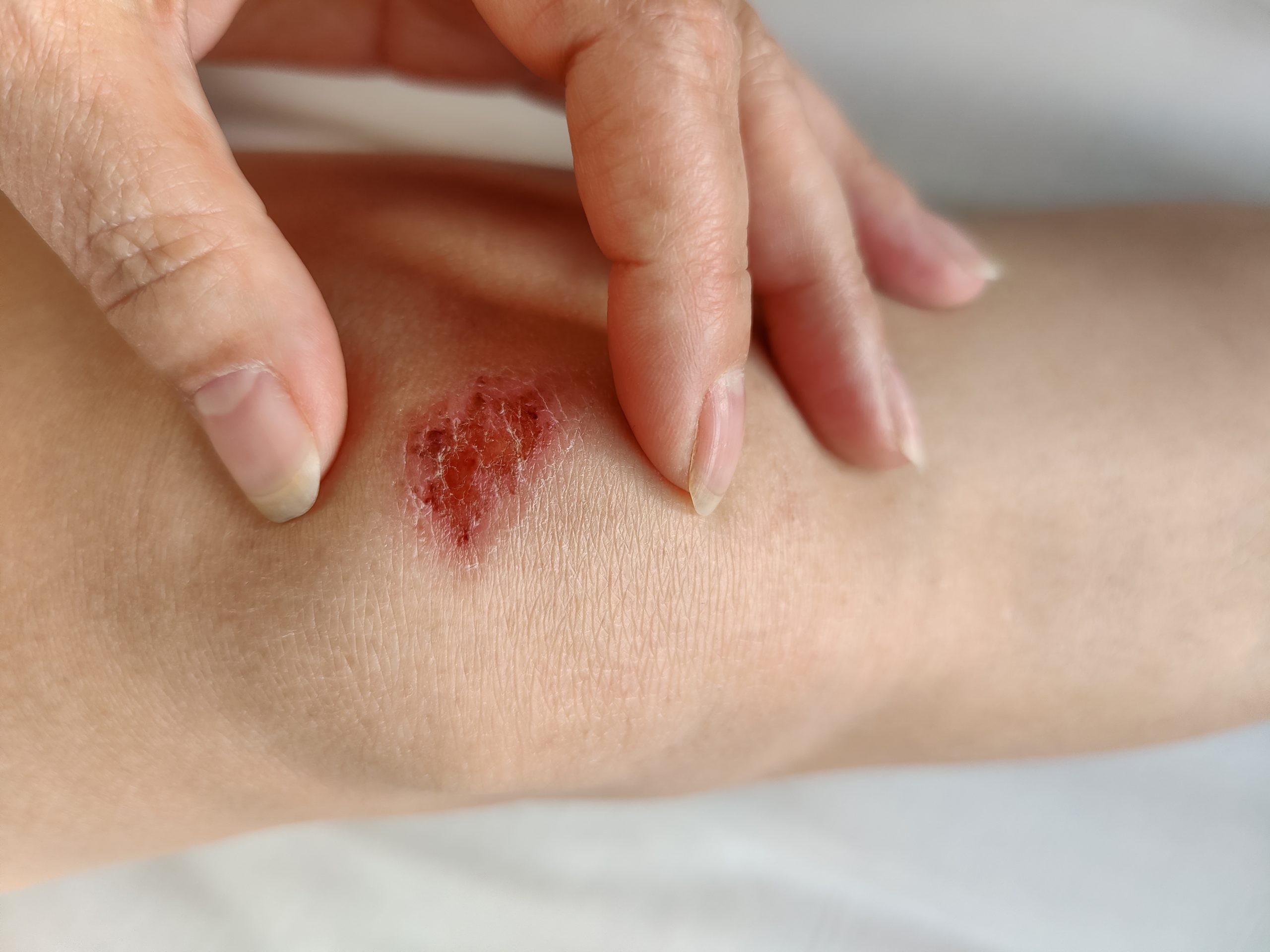 Dr. Lawrence Schmetterer at Schmetterer MD Vein & Vascular in Youngstown reviewing a patient's chronic leg wound and explaining the connection between venous insufficiency and impaired healing.